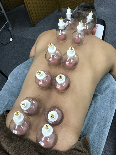 紀元前600年から受け継がれる施術。吸玉療法の6つの効果とは?