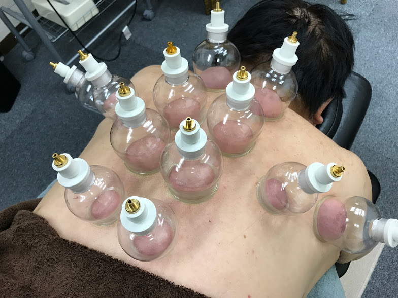 吸い玉後にできる痕の色はあなたの健康状態をあらわしている?