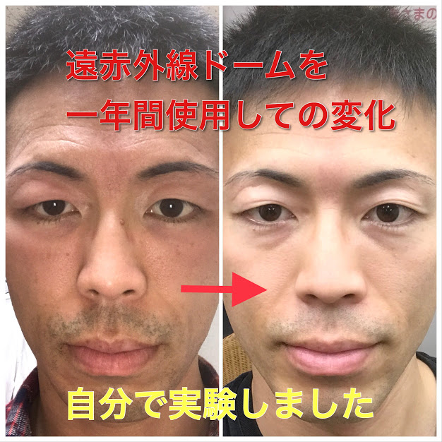 【自分で実験!】遠赤外線ドームを1年間使用すると、肌がどう変化するのか?