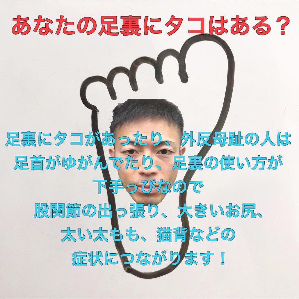 あなたの足裏にはタコがありますか?タコが及ぼす身体への影響とは?